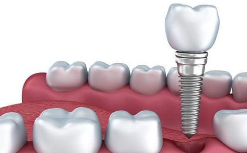 種植牙術後護理保養3建議