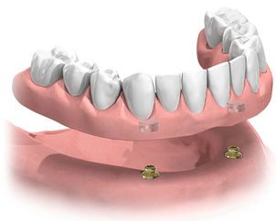 常見的對種植牙的誤區有哪些