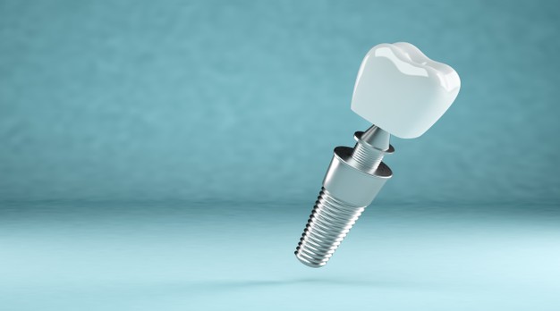一般種植牙能使用多少年？