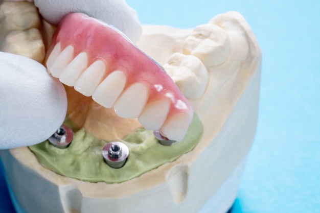 種植後牙不磨牙成功修複牙齒