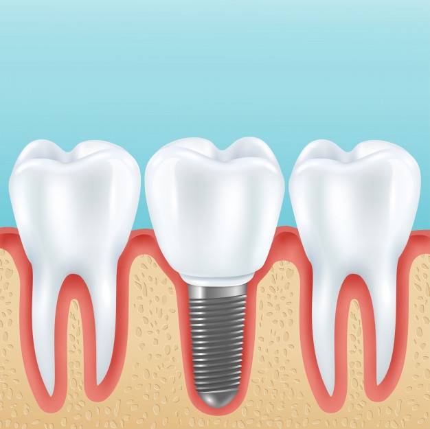 種植牙齒的認識誤區 你知道它的壽命是多長嗎