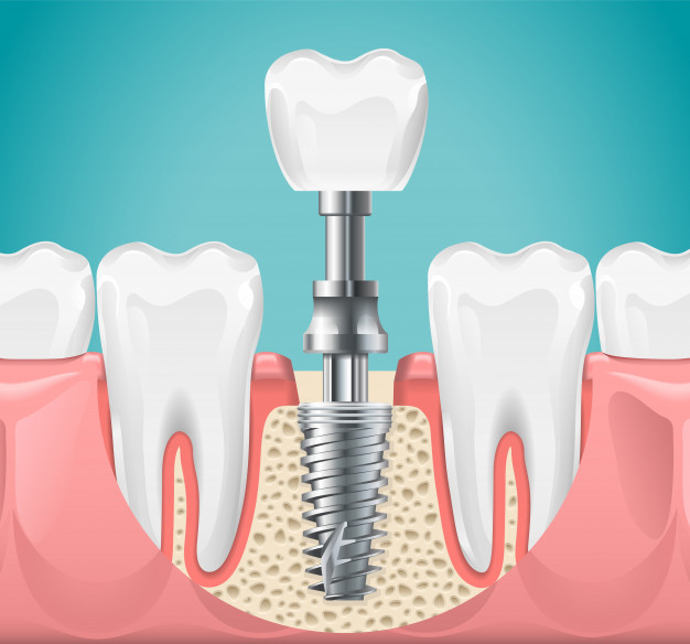 安裝單顆種植假牙的步驟是怎樣的？