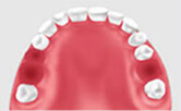 牙齒缺失修複怎麽修複呢？