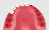 種植牙有什麽維護方法 定期複診維護最關鍵