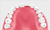 牙齒種植需要具備哪些口腔條件？
