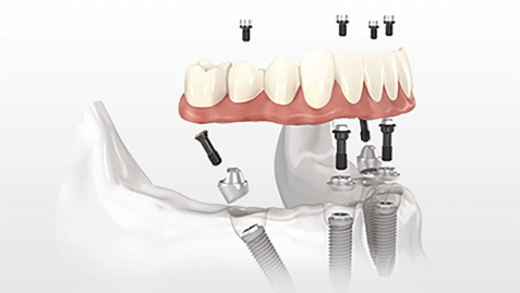 臨床實踐 - 新型牙種植體解決方案