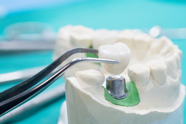 影響種植牙壽命的因素主要有三點