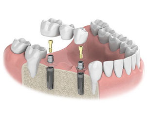 種植牙的組成部分包括哪些？