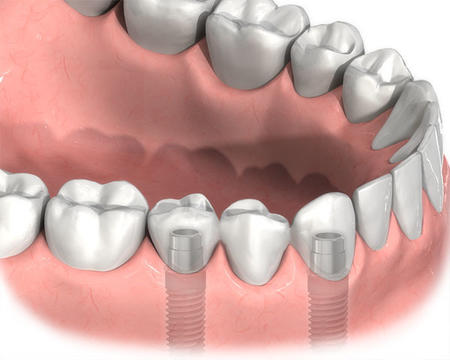 種植牙是什麽意思
