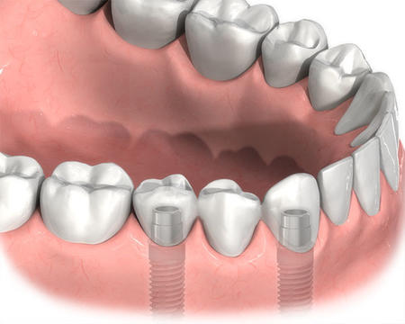 佩戴活動假牙不當致“毀容”種植牙“種”牙兼“整容”