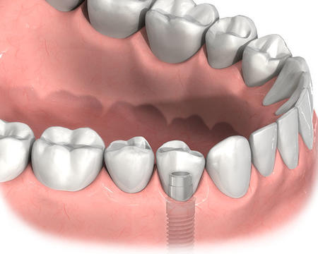 種植牙手術後要注意什麽