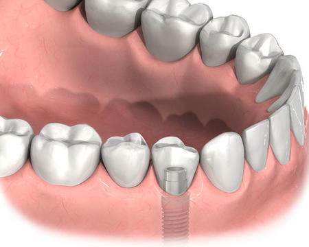 種植牙是怎麽回事 如何做種植牙
