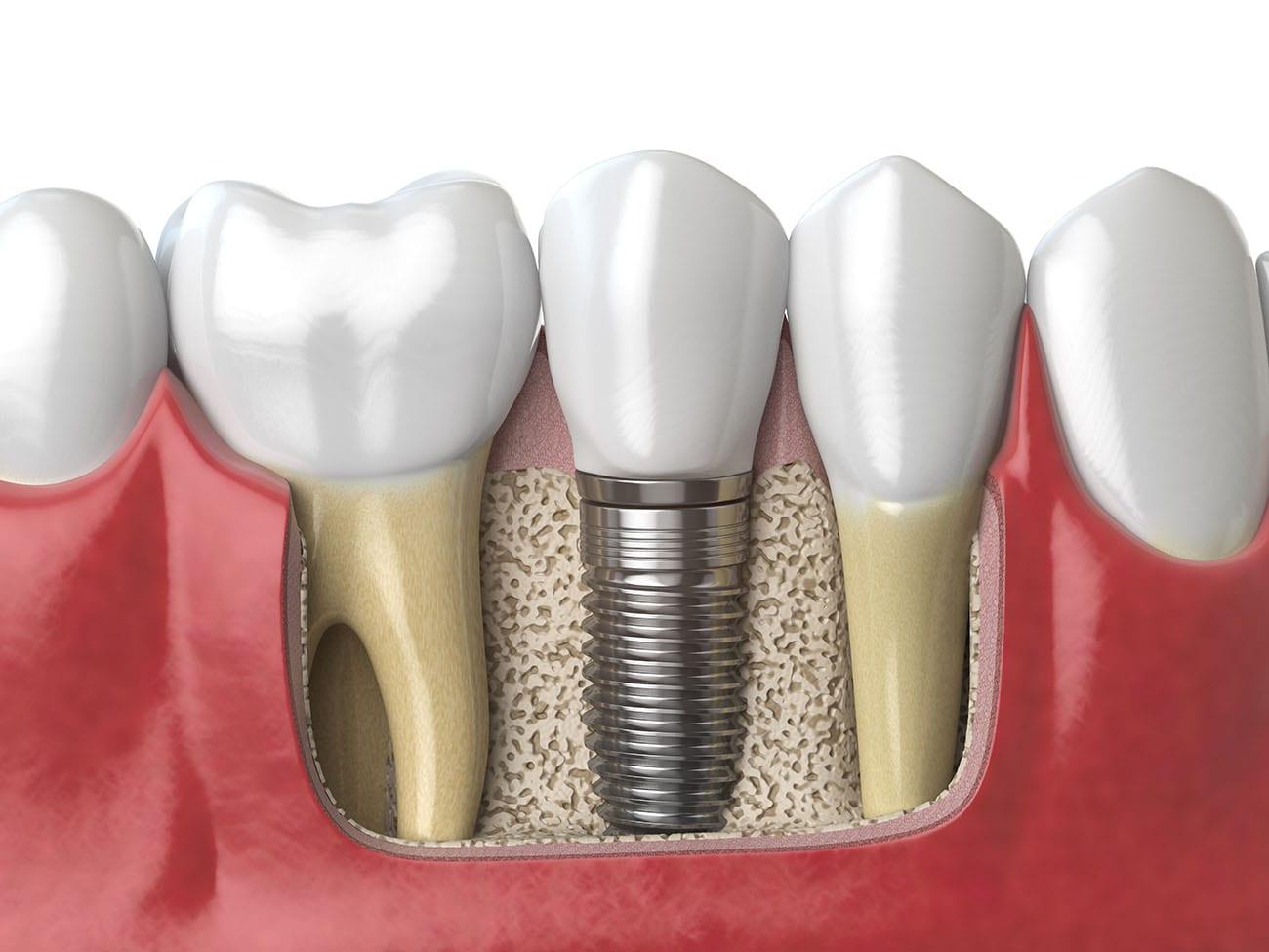 種植牙後必備的護理法是什麽呢？