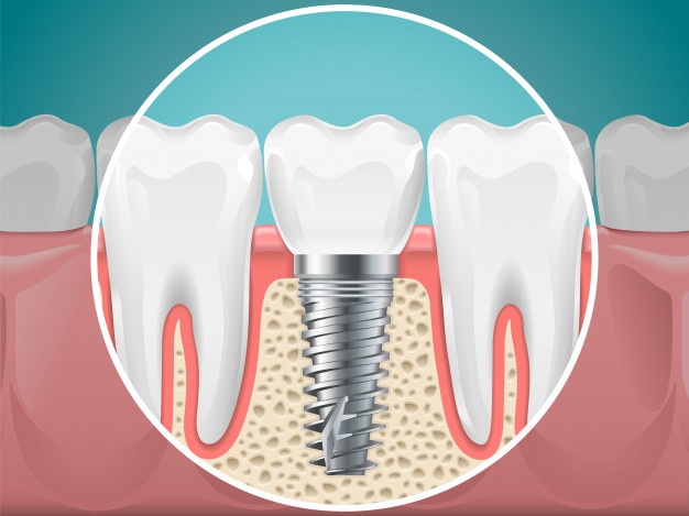 牙齒種植小心並發症 護理種植牙有這8個方法