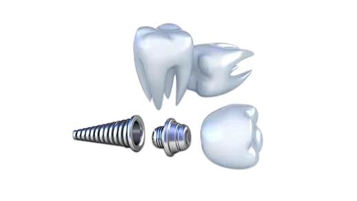 種植牙手術流程你知道嗎