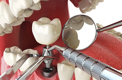 牙齒種植後 爲何後期護理更重要？