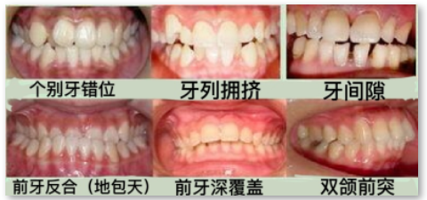 什麼樣的牙齒適合箍牙