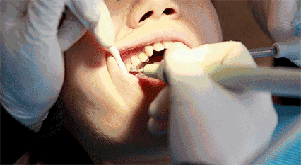 恐怖：牙周炎的终极形态 ！