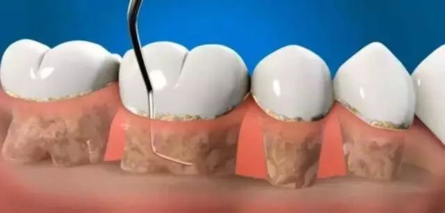碘甘油在牙科臨床上的應用妙招