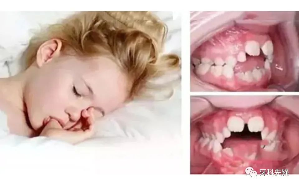 這六大口腔不良習慣導致兒童牙畸形，影響孩子顏值！發現要及時糾正！