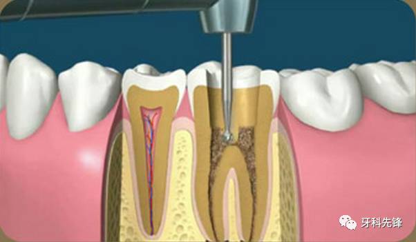 補牙不做冠療效少一半！根管治療後牙齒已經不疼了爲什麽還要戴牙冠呢？