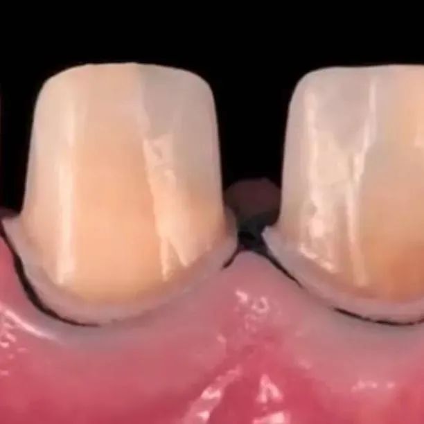 什麼是全瓷牙？揭祕大多數牙醫向您推薦的全瓷牙！