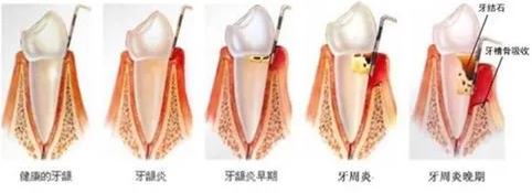 【微笑上揚】常見口腔治療項目術前術後須知