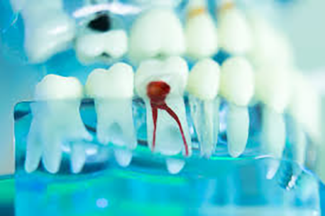 牙周病的五步治療法