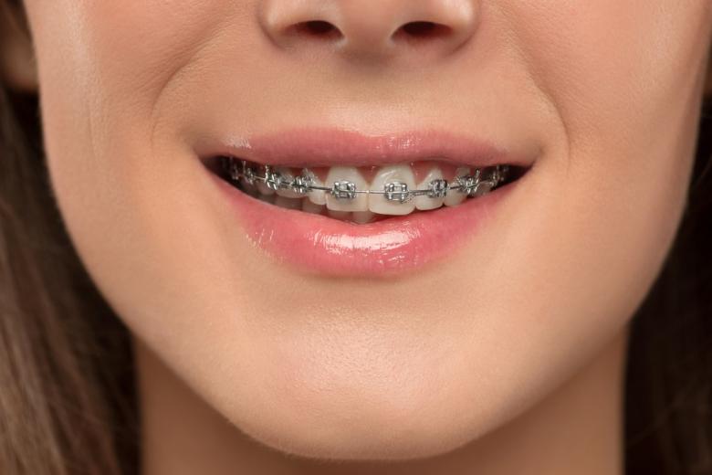 beautiful-young-woman-with-teeth-braces-37W5NCX(1)